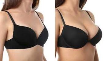 MAMOPLASTIA DE AUMENTO