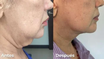 CERVICOPLASTIA