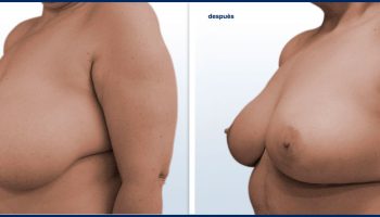 PEXIA MAMARIA CON O SIN IMPLANTES