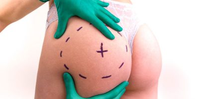 img-gluteoplastia-tipos-y-beneficios-1
